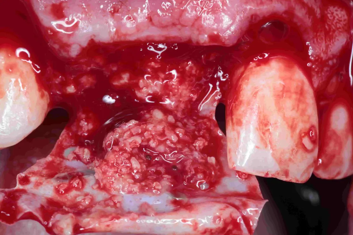 Advanced bone grafting techniques, step by step