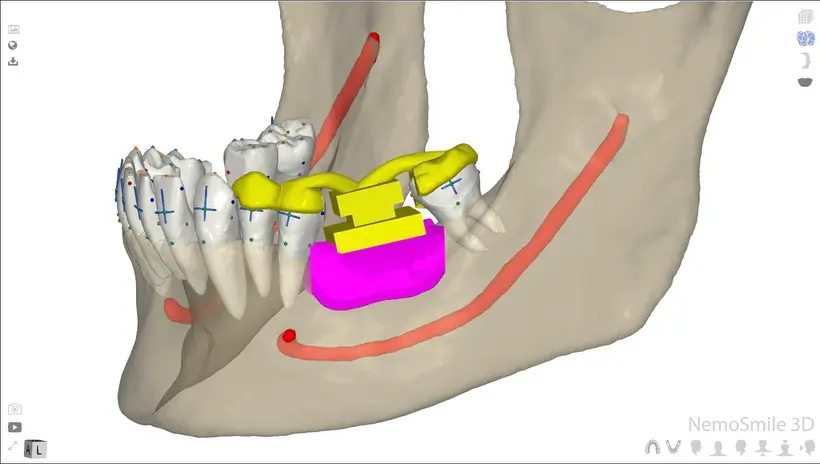 A step of the Guided Bone Harvesting protocol, planned digitally