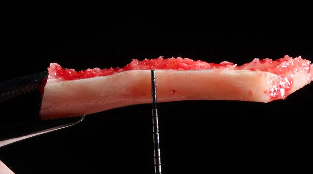 A bone block graft fixed with osteosynthesis screws, the Khoury technique