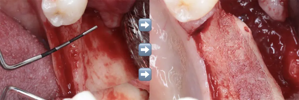 A bone graft, before and after