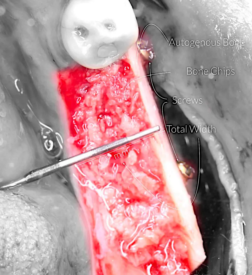A horizontal bone augmentation case