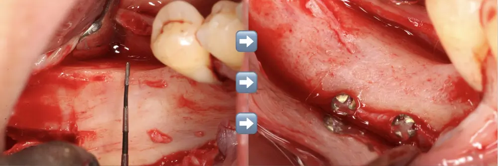 A bone reconstruction, before and after
