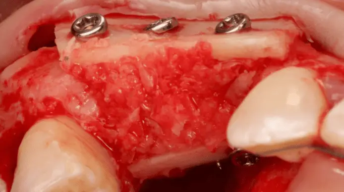 The Khoury technique for bone grafting, step by step