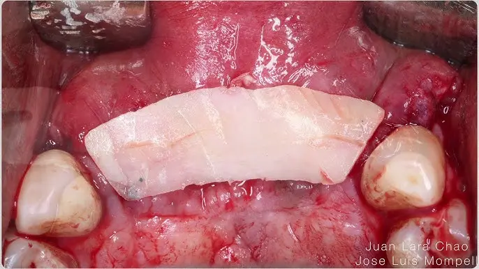 The Khoury plate technique, cortical plates in place