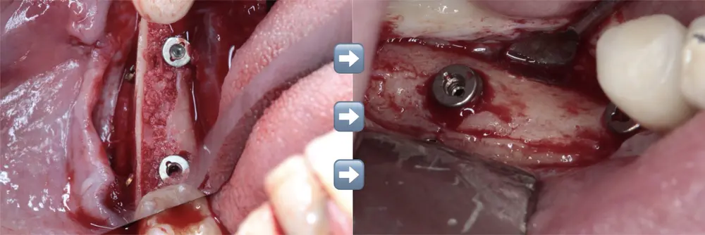 An implantology case treated with the technique
