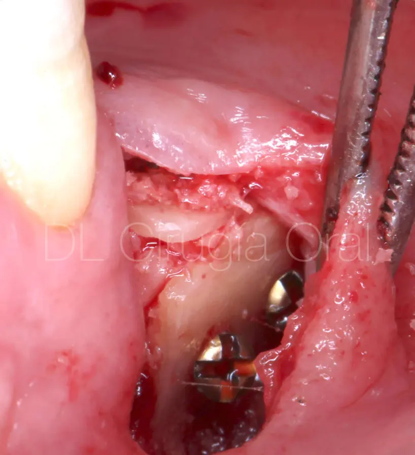 Vertical bone augmentation